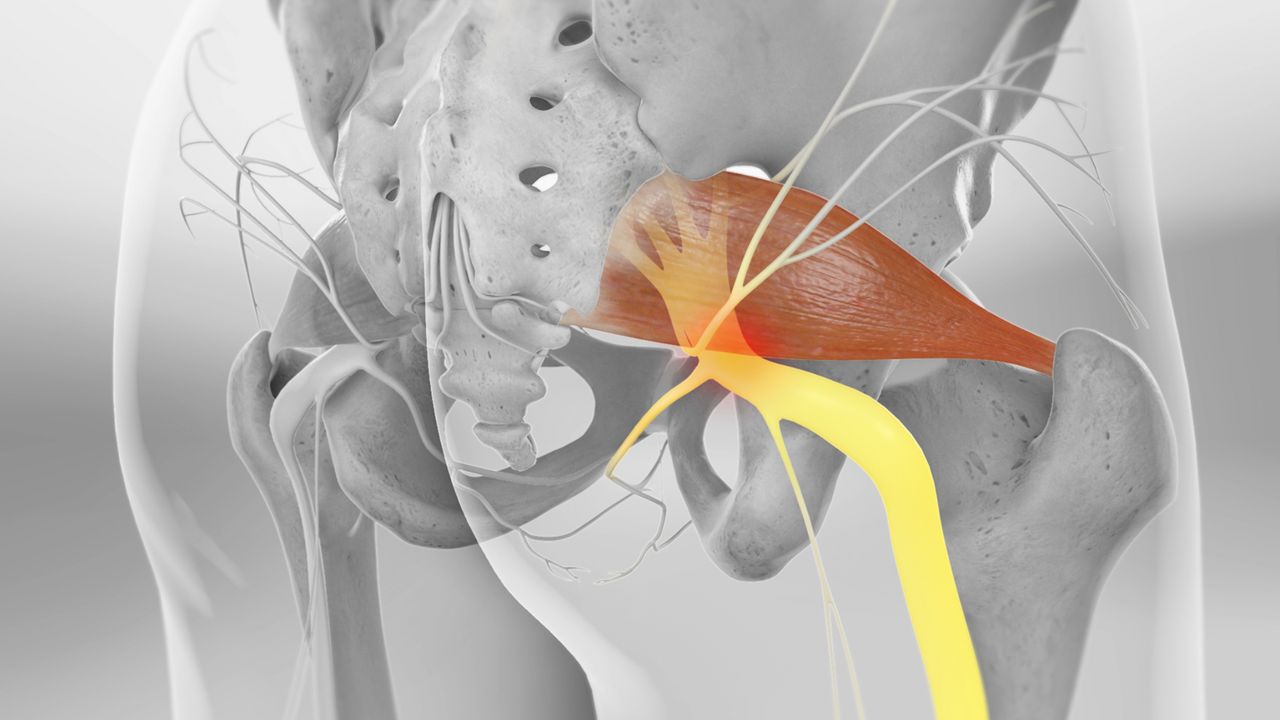 Tratament sindromul piriformis realizat într-un cabinet de fizioterapie, pentru reducerea simptomelor și corectarea cauzelor